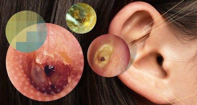 Konačno na našem tržištu. Prirodni preparat koji poboljšava sluh i najveći je neprijatelj tinitusa i infekcija uha.